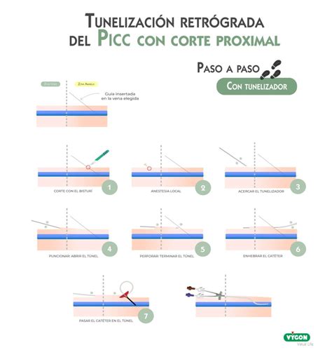 La Tunelizaci N Como Herramienta Clave En El Paciente Complejo El