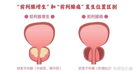 【诊疗指南】必收藏：怎么看前列腺各项检查单＋治疗方案建议 知乎