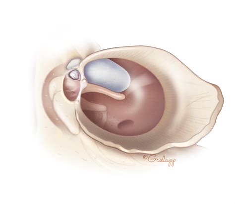 Congenital Cholesteatoma – Oto Surgery Atlas