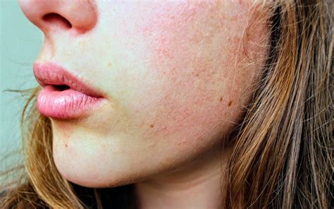 Skin Discoloration Causes | ReviewThis