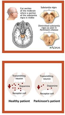 Parkinson S Disease Flashcards Quizlet