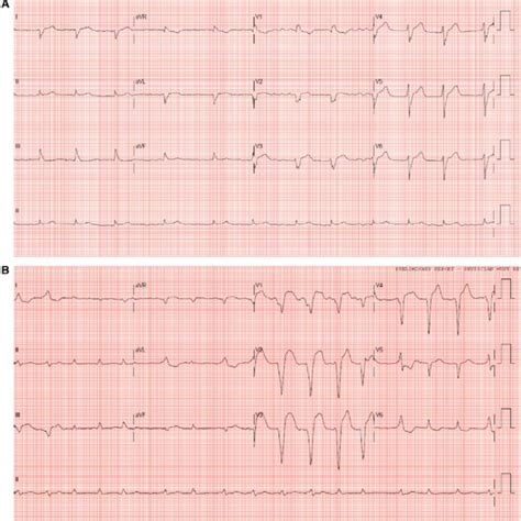 Electrocardiogram Of Patient A On Presentation Showing Atrial