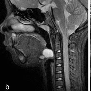 Showing vallecular cyst being excised | Download Scientific Diagram