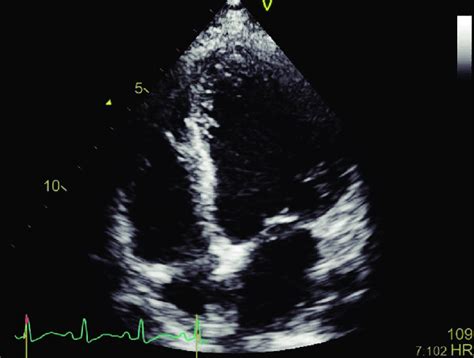 Post Pericardiostomy Transthoracic 2d Echo Apical 4c View Showing