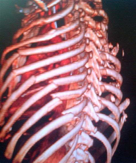 Rib Fractures And Flail Chest The Bone School