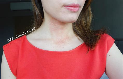 Dr Rachel Ho Retinol Burn