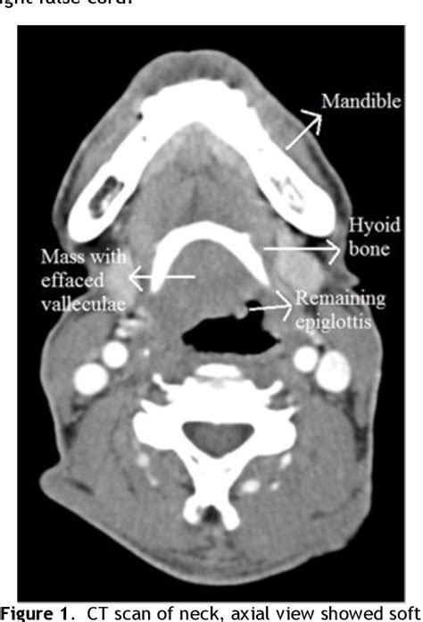 Figure 1 From A Rare Case Of Primary Extranodal Laryngeal Non Hodgkin Lymphoma Semantic Scholar