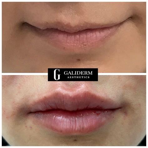 Galiderm Aesthetics Medical Spa Royal Palm Beach Florida 183