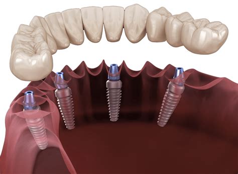 All On Four All On Six Dental Implant In Turkey Ekiz