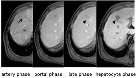 Dynamic Contrast Enhanced Magnetic Resonance Imaging Mri Findings