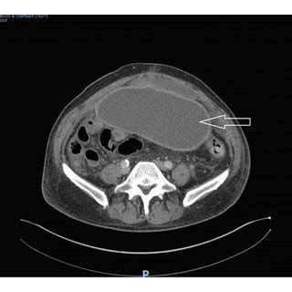 A Computed Tomography CT Abdomen Pelvis Cross Sectional View