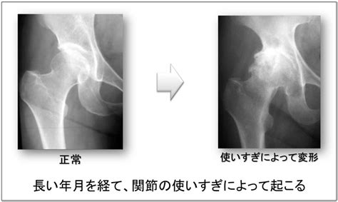 変形性股関節症の症状と治療 おおさかグローバル整形外科病院 大阪市城東区 脊椎、人工関節、スポーツ整形、ペインクリニック 牧ヘルスケアグループ 医療法人 清翠会