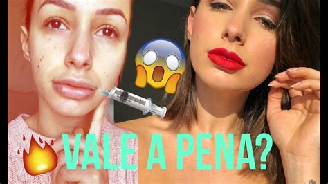 Preenchimento Labial Vale A Pena Preço And Dicas Youtube