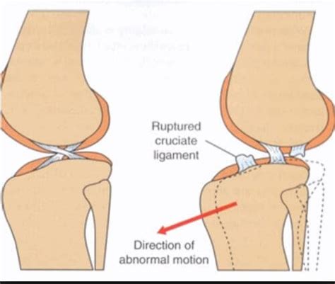 Why Choose MMP Over TPLO for Cranial Cruciate Ligament Tear Of The Dog ...