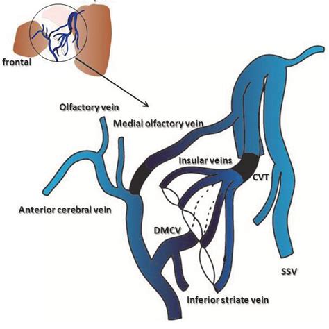 Surface anatomy of the left sylvian fissure A Intraoperative photograph... | Download Scientific ...