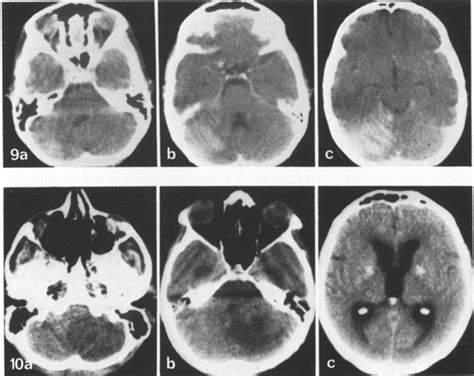 a-e. Left superior cerebellar artery occlusion. Contrast-enhanced CT ...