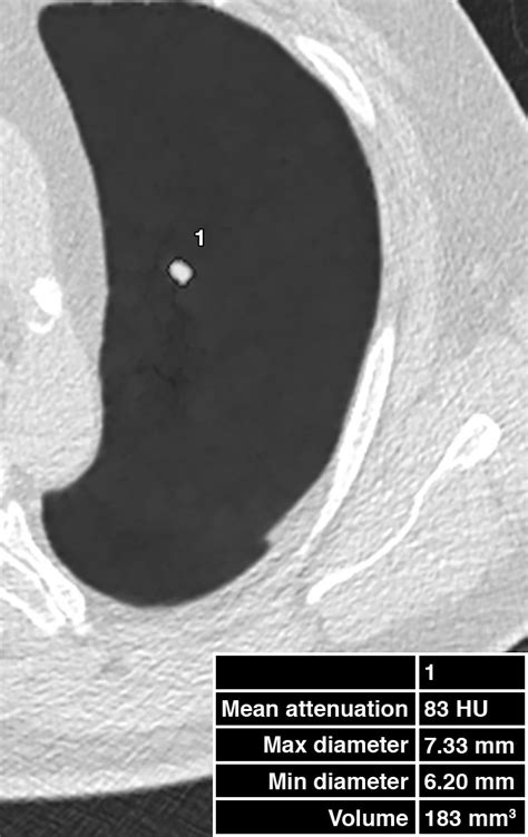 Journal Club Computer Aided Detection Of Lung Nodules On Ct With A Computerized Pulmonary