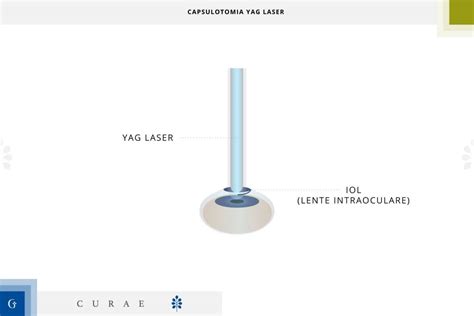 hőmérő Függelék Téglalap capsulotomia yag laser occhi Horzsolás