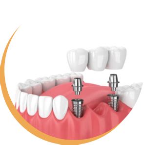 Dental Implants Perth Oral Maxillofacial Consultants