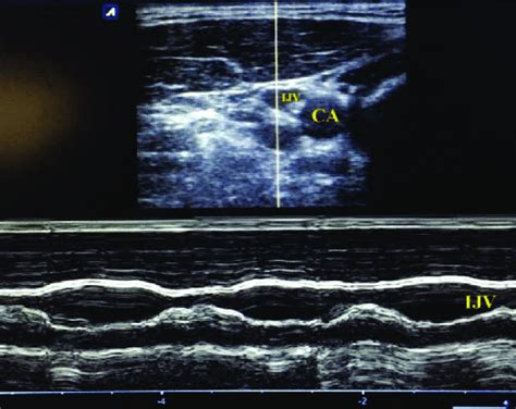 Measuring Right Internal Jugular Vein Ijv Diameter In Healthy