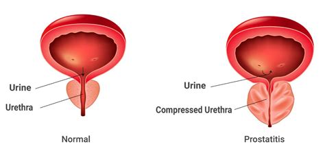 Prostatitis Explained Symptoms Causes And Treatment Guide