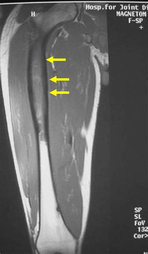 Ewing Sarcoma Bone Tumor Cancer Tumors Of The Bone