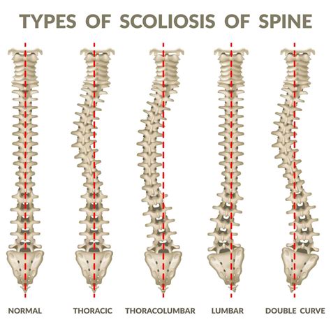 Scoliosis Hart Garner Md Minnesota Spinal Neurosurgeon