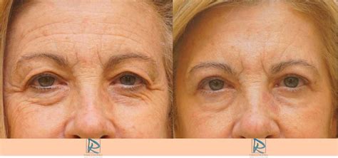 Blefaroplastia Antes Y Despu S Dr Marco Romeo