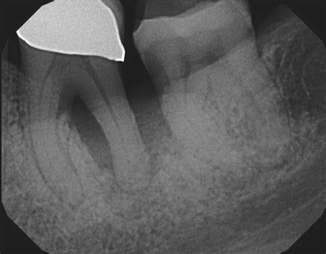 Tooth Abscess Xray