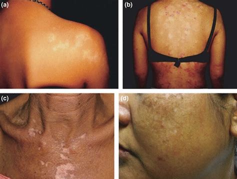 Postinflammatory hypopigmentation, causes, symptoms, diagnosis, treatment & prognosis