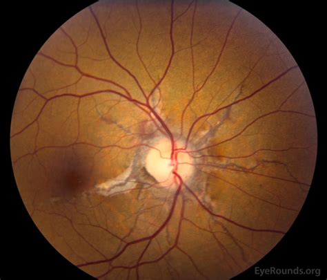 Angioid Streaks And Optic Disc Drusen In Pseudoxanthoma Elasticum The