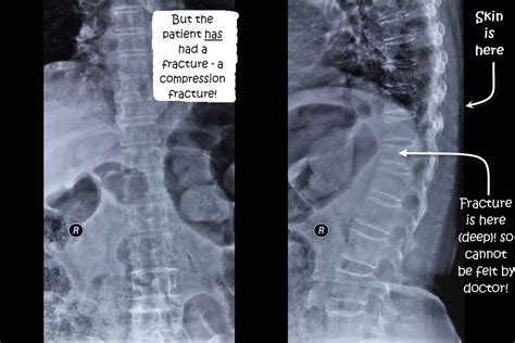 X Ray thoracic compression fractures | Abingdon Chiropractic Clinic