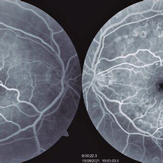 A Fluorescein Angiography Of The Right Eye Showing Macrovessel