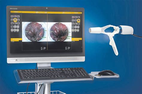 El VPH en la zona anal riesgos y prevención