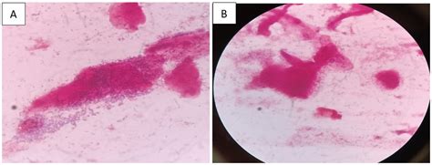 Gram Stain Day Ii Of Vaginal Smear Showing Vaginal Epithelial Cells