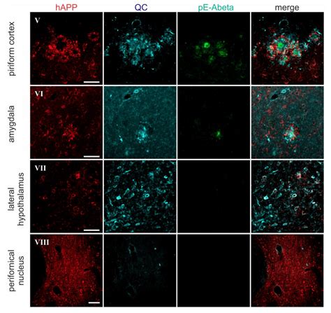 Triple Immunofluorescent Labeling Of Happ Qc And Pe Abeta Happ Qc