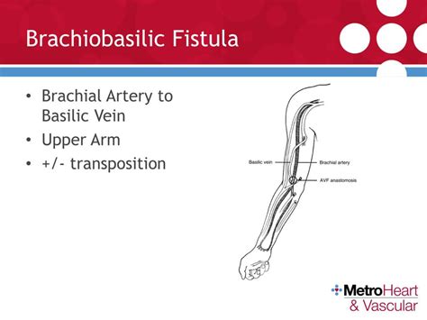 Ppt Arteriovenous Fistulas Types Trends Physical Examination