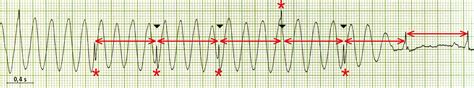 Caso Cl Nico Ecg Despu S De La Cardioversi N El Ctrica P Gina