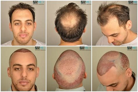 Norwood 6 Hair Transplantation Results Asmed Hair Transplant