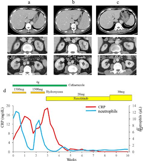 Contrast Enhanced Computed Tomography Scans A On Admission B Two