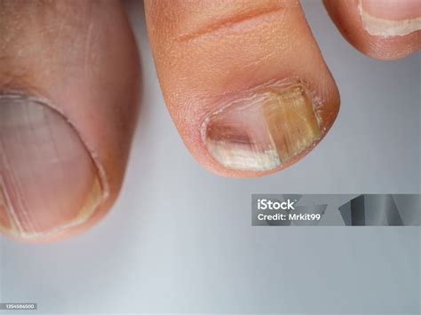 Nail Infections Caused By Fungi Such As Onychomycosis Also Known As Tinea Unguium Caused By