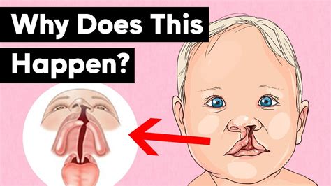 Cleft Lip And Cleft Palate Explained Youtube