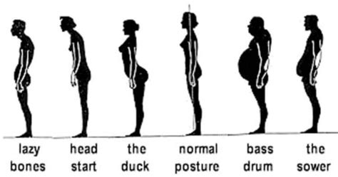 Sway Back Posture A Common Postural Variation Sydney Physio Clinic