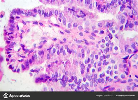 Carcinoma Papilífero Tiróide Micrografia Luz Foto Microscópio Tipo Mais