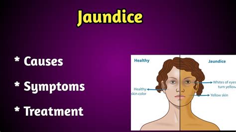 Jaundice Causes Symptoms And Treatment Youtube