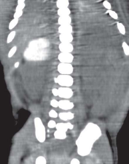 The Adrenal Glands Adrenal Masses Radiology Key