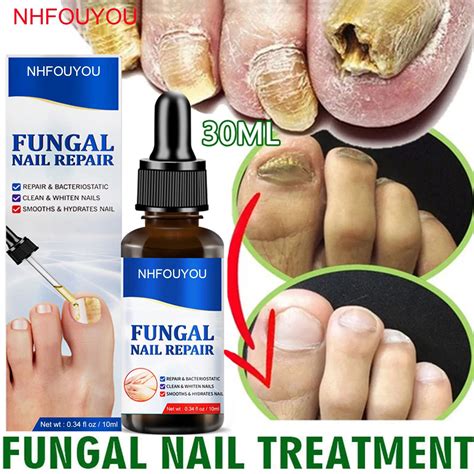 Fungal Nail Treatment Oil Foot Repair Essence Toe Nail Fungus Removal Gel Anti Infection Cream