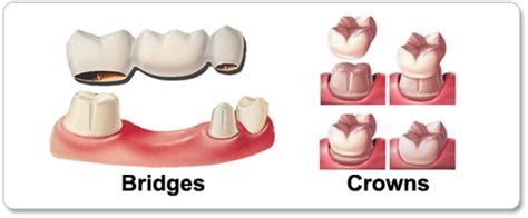 Crowns And Bridges