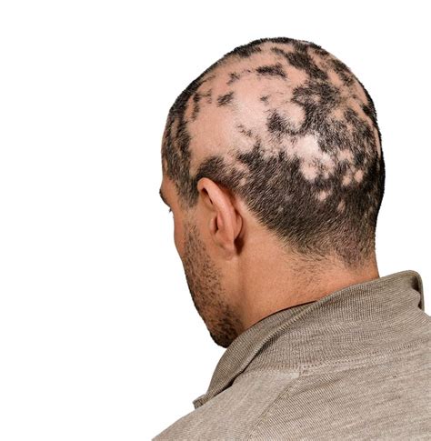 The Role Of Autoimmune Diseases In Hair Loss Hair Loss Treatment