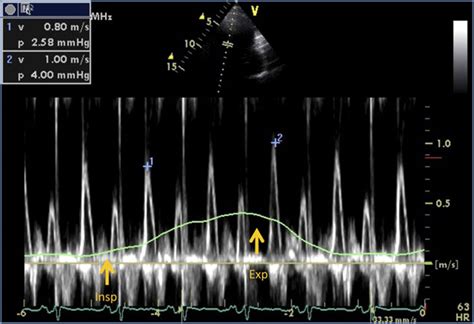 Echocardiographic Diagnosis Of Constrictive Pericarditis Circulation Cardiovascular Imaging